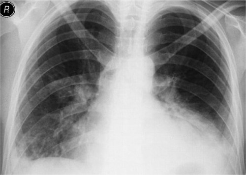 Figure 1 Chest X-ray of patient showing bilateral lower lobe pulmonary infiltration with right-sided pleural effusion.