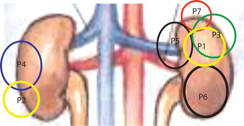 Figure 1.  Approximate size and location in the kidneys of all tumors treated. Note that all patients had only one kidney at SBRT. This summation pictures what a projection of the treated tumor looks like in a normal individual.