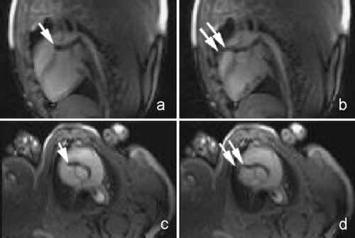 Figure 2. Real‐time True FISP sagittal (a,b) and axial (c,d) images were acquired. a, c show catheter engaged in right coronary artery without contrast injection; b,d show catheter in right coronary artery during injection of 25% diluted Gadolinium contrast. With injection, the right coronary artery can be visualized as a dark curvilinear structure (dual long arrows).
