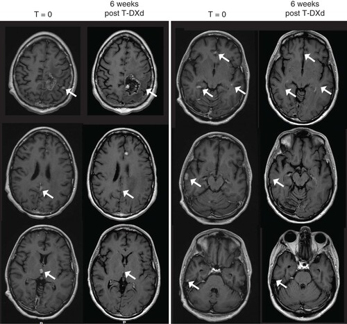 Figure 1. Multifocal brain metastasis response to T-DXd. Side-by-side comparison of post contrast, T1-weighted MRIs done before (left-sided panels) and 6 weeks after initiation of T-DXd. Each arrow indicates a metastasis that resolved after treatment initiation.TDXd: Trastuzumab deruxtecan.