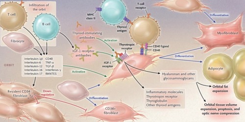 Figure 1 Pathophysiology of thyroid eye disease. In TED, B-lymphocytes, T-lymphocytes, and CD34+ fibrocytes infiltrate the orbit. CD34+ fibroblasts, originating from bone marrow-derived fibrocytes, further differentiate into myofibroblasts or adipocytes. Both CD34+ and residential CD34− fibroblasts are present within the orbit, and depending upon microenvironment-mediated signaling, can produce cytokines, including IL-1β, IL-6, IL-8, IL-16, TNF-α, RANTES, and CD40 ligand, which activate orbital fibroblasts. CD34+ fibroblasts express low levels of TSH-R, thyroglobulin, and additional thyroid antigens. TSIs activate the TSH-R/IGF-1R complex inducing inflammatory molecule expression and glycosaminoglycan synthesis. Furthermore, immunoglobulins directed against IGF-1R induce orbital fibroblast signaling, thereby increasing cytokine and hyaluronan production, and subsequent orbital tissue expansion, leading to proptosis and compression of the optic nerve. Adipogenesis also leads to orbital fat expansion. From N Engl J Med, Smith TJ, Hegedus L, Graves’ disease, 375(16), 1552–1565. Copyright © (2016) Massachusetts Medical Society. Reprinted with permission from Massachusetts Medical Society.Citation4