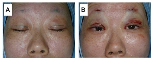 Figure 2 (A) Marking of the incisions before the procedure. The skin incision was made 6 mm from the eyelids margin, and the central area of the upper brow margin was also incised. (B) A view of the skin incisions before closure. With autologous fascia lata, bilateral frontalis slings were performed.