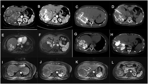 Figure 4. A case of complete tumor ablation selected from our study. The patient with huge unresectable HCC achieved complete ablation after receiving step-by-step debulking MWA therapy post-TACE-refractory. (A) CT scan of the huge unresectable HCC prior to treatment. (B) After three TACE procedures, the tumor remained unchanged with unsatisfied deposition of iodized oil, which was deemed as TACE-refractory. (C,D) Heavy ablation stage: patients underwent three cycles of heavy ablation. (E,F) MRI scans showed elimination of >80% active tumor tissues. (G,H) Residual tumor ablation stage: patients underwent five rounds of targeted MWA according to MRI results. (I-L). MRI scan showed the huge HCC was completely eliminated by our step-by-step debulking MWA. HCC: hepatocellular carcinoma; TACE: transarterial chemoembolization; MWA: microwave ablation; CT: computed tomography; MRI: magnetic resonance imaging.