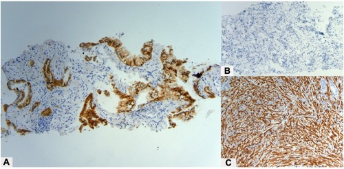 Figure 2 (A) ALK immunohistochemical staining of the needle biopsy specimen from October 2015, showing nearly diffuse expression of weak to moderate intensity. No background staining is present (10x, ALK, Novocastra 5A4). For comparison, a negative control is shown (B, 10x), consisting of the immunohistochemistry reaction without the primary ALK antibody; the lack of staining in the negative control (B) confirms that ALK staining in the patient sample (A) is due to the detection of the antigen. A positive control is also shown (C, 10x), showing diffuse ALK expression in a sample of an inflammatory myofibroblastic tumor, which is known to express the ALK protein.