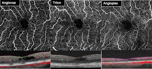Figure 1 SCP images and segmentation using Optovue RTVue-XR, Topcon DRI-OCT Triton Swept-Source OCT, and Zeiss Cirrus 5000-HD-OCT Angioplex.