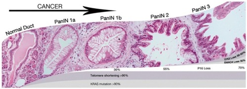Figure 2 Pancreatic progression from PanIN-1 to PanIn-3.Notes: Reproduced with permission from Hackeng WM, Hruban RH, Offerhaus GJA, Brosens LA. Surgical and molecular pathology of pancreatic neoplasms. Diagn Pathol. 2016;11(1):47.Citation27