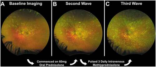 Figure 4. Case 2 left eye, ultra-widefield retinal imaging. A. Left eye appearance at presentation. B. Left eye appearance 14 days following the initiation of a reducing course of oral prednisolone, commenced at 60 mg a day. C. Left eye appearance at 37 days post-3 daily 1 g intravenous methylprednisolone doses.