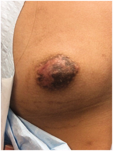 Figure 4. One month following second CO2 laser ablation of the residual NAC angiofibroma. The nipple is noted to have more definition following the second treatment. Laser treatments were separated by 4-week interval. Candela CO2RE. Mode: classic. Fractional density: 100%. Fluence: 2 mJ.