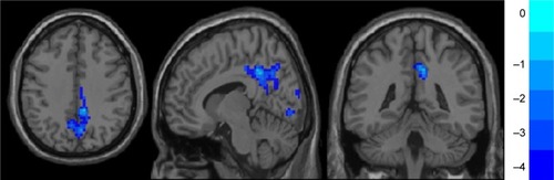 Figure 1 Lower ALFF value in the MDD group: bilateral precuneus, posterior cingulate cortex, right middle cingulate cortex, right calcarine, left calcarine, right lingual gyrus, and left cuneus.
