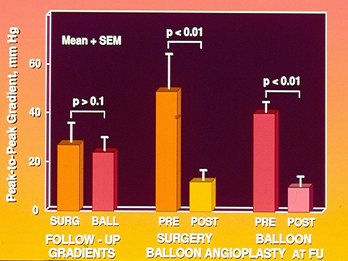 Figure 9 Bar graph shows comparison of residual pressure gradients at follow-up (left panel) after surgical (SURG) and balloon (BALL) therapy and of the results of repeat balloon angioplasty (middle and right panels, respectively). Note similar (p > 0.1) residual gradients at follow-up (left panel). Also, note that there is a significant (p < 0.01) fall in pressure gradients in both groups (middle and right panels) after repeat balloon angioplasty at follow-up (FU). Mean + standard error of mean (SEM) are shown. Modified from Rao PS, Chopra PS, Koscik R, Smith PA, Wilson AD. Surgical versus balloon therapy for aortic coarctation in infants ≤3 months old.J Am Coll Cardiol. 1994;23:1479–1483.Citation42 doi: 10.1016/0735-1097(94)90395–6.