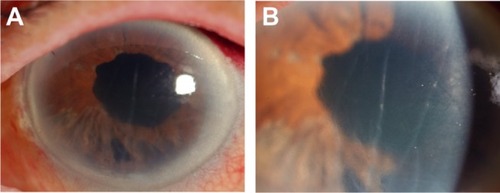 Figure 2 Slit lamp photographs of the left eye after cataract surgery with iridectomy. After the first surgery, slit lamp microscopy shows the implanted intraocular lens and partial removal of the iris in the lower quadrant (A). Corneal edema with Descemet’s folds are observed even in central corneal stroma (B).