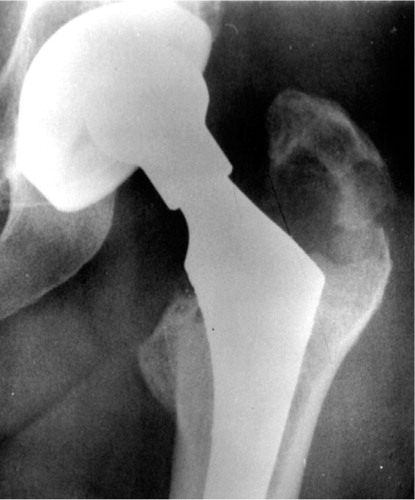 Figure 3B. 3 months later, the same patient experienced sudden lateral hip pain after a minor strain. The radiograph showed a displaced fracture through the cyst. She underwent surgery to fix the fracture, bone graft the cyst, and revise the metal shell and the liner.