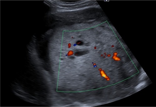 Figure 1 Abdominal ultrasound of the abdomen. Well-defined, large nonhomogeneous mass lesion at the area superior to the left upper kidney.
