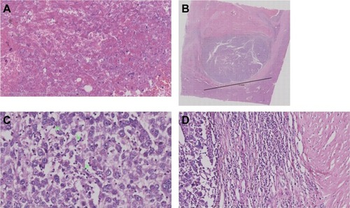 Figure 3 Microscopical features of the case of HCC spontaneous regression.