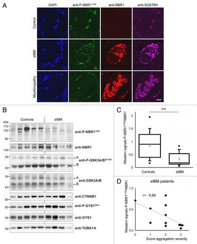 Figure 5. NBR1 phosphorylation is decreased in muscles of sIBM patients. (A) Confocal pictures of muscle sections from control, sIBM, and myotilinopathy patients stained for phospho-NBR1T586 (green), NBR1 (red), and SQSTM1 (violet). One to 5% of muscle fibers of sIBM patients show such protein aggregates. Nuclei were revealed with DAPI. All pictures have been acquired with the same laser gains. Scale bar: 20 μm. (B) Western blot analysis of endogenous phosphorylated and total NBR1, GSK3, and GYS1, and total CTNNB1 in protein extracts from control and sIBM patient muscle biopsies. (C) Tukey box plot of western blot phospho-NBR1T586 on NBR1 signal ratio. Boxes are delimited by quartiles Q1 and Q3 and crossed by median. Gray cross is the mean. Ends of bars are first and ninth deciles. Circles are minimum and maximum. Width of boxes is proportional to the effective: n = 14 controls and 13 sIBM patients. One sIBM sample with an extreme value has been excluded by Grubbs test at 5%. **P < 0.01, Student t test. (D) anti-P-NBR1T586/anti-NBR1 signals of each sIBM patient determined by western blot are represented as a function of scores of protein aggregation severity (cf Table S1). In gray is the trend line. r = Spearman rho correlation coefficient. P < 0.05: there is a significant inverse correlation between the level of remaining phospho-NBR1T586 and the severity of protein aggregation in sIBM muscle.