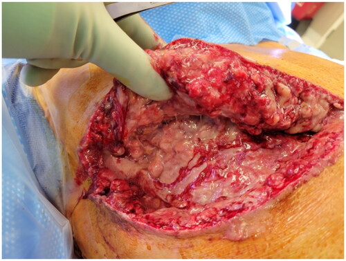 Figure 4. Intra-operative examination of widely disseminated milky fluid within the breast pocket during first washout procedure.