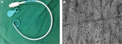 Figure 2 Appearance of the pigtail catheter.Notes: (A) Gross appearance of the catheter. (B) Scanning electron microscopy findings of the drug-eluting PLGA nanofibers (20,000× magnification).