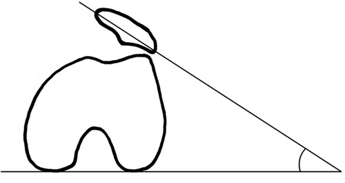 Figure 4. Patella inclination angle (PIA): the angle between the transverse axis of the patella and the bicondylar line.