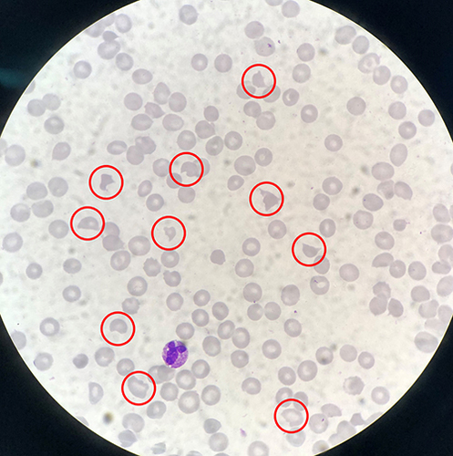 Figure 1 Schistocytes found in the peripheral blood smear on 2022-10-11 (in the red circle).