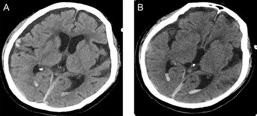 Figure 2 Head computed tomography (CT) scans of a 77-year-old woman with severe C. psittaci pneumonia. CT scan (October 12) revealed a right subdural hematoma and subarachnoid hemorrhage (A); CT scan (October 16) revealed the right subdural hematoma and subarachnoid hemorrhage were significantly absorbed (B).