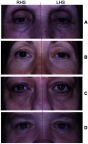 Figure 6 Photographs of (A) 72-year-old, (B) 51-year-old, (C) 59-year old and (D) 41-year-old women who applied the placebo cleanser/moisturizer to the left side of the face (LHS) and the test cleanser/moisturizer to the right side of the face for 28 days. Fine wrinkles are decreased and the skin is smoother on the RHS compared to the LHS.