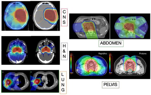 Figure 1. Comparison of treatment plans with X-rays and protons, showing normal tissue sparing in every tumors site. Figure from (Durante et al. Citation2019), reproduced with permission of elsevier.