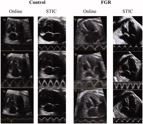 Figure 1. Examples of left (superior), right (middle), and septal (inferior) LAD measurements using online and STIC M-mode in a normally grown fetus (control) and case of fetal growth restriction (FGR).