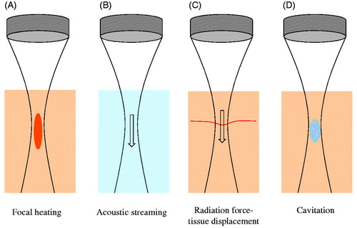 Figure 1. Schematic of HIFU-induced effects. (A) Thermal elevation is proportional to tissue absorption and time average intensity, occurring preferentially within the transducer focal region. This can ablate vessels. (B) Flow within fluid (e.g. blood) is induced by acoustic streaming, which occurs as a result of momentum imparted by the ultrasound wave to the propagating medium. (C) In tissue, radiation force induces displacements in the direction of ultrasound propagation – a phenomenon that can displace blood vessel walls. (D) At sufficiently high peak negative pressures, cavitation can be induced – leading to a spectrum of vascular effects such as haemorrhage or the formation of thrombus.