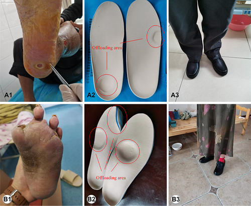 Figure 2 Profiles of patients’ foot conditions and offloading therapy. Patient A: Recurrent neuropathic plantar foot ulcer on the left heel and the fifth right plantar metatarsophalangeal joint (A1). Personalized offloading insoles (A2). Wearing of the offloading footwear (A3). Patient B: Recurrent neuropathic plantar foot ulcer on the right foot and amputation of the first and third toes of the left foot (B1). Personalized offloading and orthopedic insoles (B2). Wearing the offloading footwear (B3).