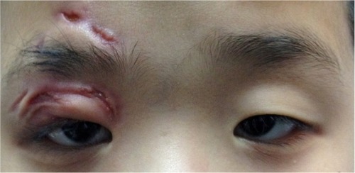 Figure 3 Right upper eyelid healed with scarring but without ptosis at 3 months post-removal of Gore-tex material.