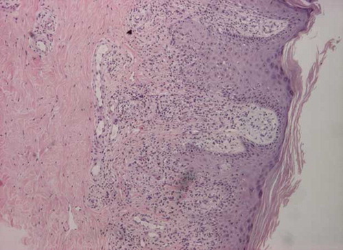 Figure 1. Lichenoid lymphocytic infiltration, few eosinophils, and characteristics of exocytosis. Epidermis shows acanthosis, focal parakeratosis, and spongiosis.