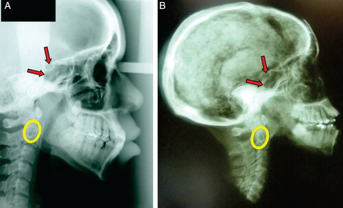 Figure 2. Radiological confrontation posing some of the elements used for this positive identification: morphology of the sella turcica (red arrows) and the aspect of the axis bone trabeculate (yellow ellipse). (A) Antemortem examination in 2009 provided by family members of the missing person. (B) Postmortem examination of the unidentified body performed by the forensic team in 2014.