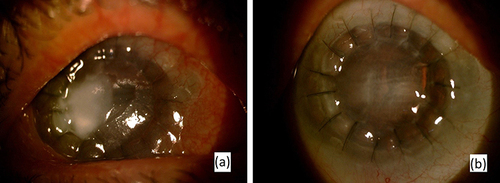 Figure 6 Fungal keratitis before PACK-CXL (a) and after PACK-CXL (b).
