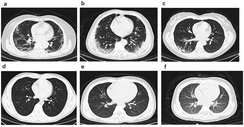 Figure 1. Chest CT images. (a) Transverse chest CT images from Case 1 showing bilateral ground-glass opacity, subsegmental areas of consolidation and subpleural line. (b) Transverse chest CT images from Case 2 showing peripheral pulmonary parenchymal ground-glass and consolidative pulmonary opacities. (c) Transverse chest CT images from Case 3 showing subsegmental areas of ground-glass opacity and consolidation. Transverse chest CT images from Case 4 (d), Case 5 (e) and Case 6 (f) were normal.