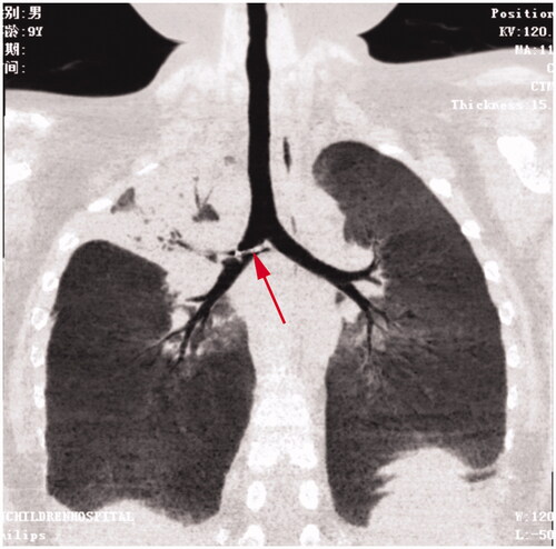 Figure 1. A needle-like metallic foreign body in the right main bronchus and right upper lobe bronchus.