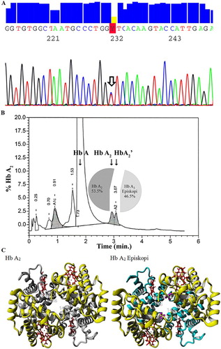 Figure 1. Characterization of the Hb A2 Episkopi mutation (a) Sequencing revealed a GCT > GTT codon change (A143V, indicated by an arrow) for δ-globin underlying the observation of a novel variant. (b) CE-HPLC analysis reveals a split peak at the Hb A2 position (expected elution time 2.9 minutes), with a trailing peak (elution time 3.07 minutes) of comparable height to the normal Hb A2, indicating a variant of similar stability. The inlayed cake diagram shows the relative abundance of each Hb A2 species. (c) The known Hb A2 tetramer structure (PDB 1si4 [Citation9], left panel) has been energy-optimized using FoldX to accommodate the A143V amino-acid change (right panel), which is located five amino acids from the carboxy-terminus of δ-globin. For a comparison of the most common Cypriot variants, see online supplementary material Fig. S2. The α- and δ-globin chains (α1, α2 and δ1, δ2) are displayed as flat ribbon diagrams in grey turquoise and yellow, respectively, with residue V142 in each mature δ-globin chain highlighted in mauve and displayed as a ball-and-stick diagram. Numbers indicate the δ-globin C and N termini and the variant amino-acid. Haeme groups are shown as stick diagrams in red.