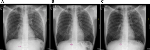 Figure S1 Chest X-rays of Patient 1 depicting (A) infiltrates on both lungs; (B) persistent fibrosis in the left lung; and (C) cavities in the left lung.