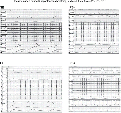 Figure 3. The raw signals during spontaneous breathing (SB) and each three levels (PS−, PS, PS+).