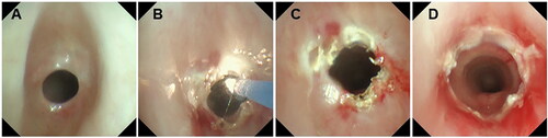Figure 2. The bronchoscope image of a 27-month-old boy with severe subglottic web-like stenosis. (A) Grade IV subglottic web-like stenosis. (B) Holmium laser ablation. (C) Balloon dilatation after airway expansion. (D) The morphology of subglottic airway after holmium laser ablation and CO2 cryotherapy.