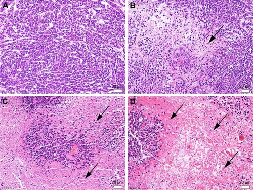 Figure 4 Morphologies of KBV tumor by H&E staining.Notes: (A) Control; ×200. (B) MSNP-PEI/MDR1-siRNA; ×200. (C) MSNP-PEI-DOX; ×200. (D) MSNP-PEI-DOX/MDR1-siRNA; ×200. The black arrows indicate dead cells resulting in the formation of a uniform pink area.Abbreviations: DOX, doxorubicin; H&E, hematoxylin and eosin; MDR, multidrug resistance; MSNP, mesoporous silica nanoparticles; PEI, polymerpolyethylenimine.
