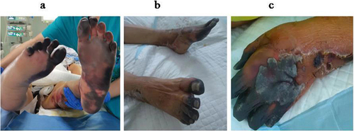 Figure 6 Manifestations of SPG Following SDSE Infection.