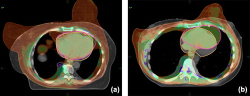 Figure 2. Image fusion of the CT scans acquired in the prone versus the supine position illustrates that, if the heart is adjacent to the chest wall in both positions, the prone position helps prevent heart exposure through separation of the breast from the chest wall (a); if the heart is distant from the chest wall in the supine position, the dose to the heart is increased due to its shift to the chest wall in the prone position (b). (greyscale: supine, color: prone).