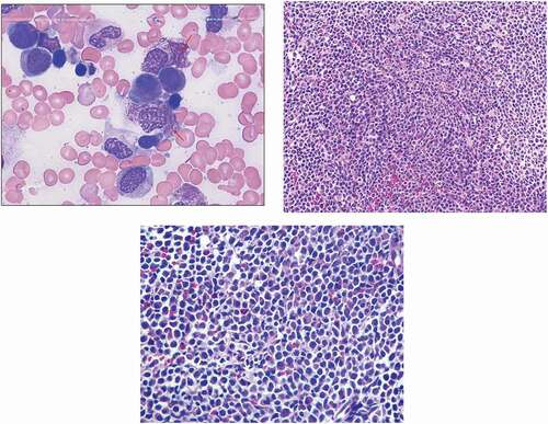 Figure 3. a.Bone marrow aspirate smear showing promyelocytes with ovoid to monocytoid nuclei, abundant cytoplasm with numerous pink, red or purple granules that obscure the nuclear outline. the cells contain numerous intertwining auer rods (arrows). b. The bone marrow biopsy showing hypercellularity with aggregates of promyelocytes (x200). c. High power image showing promyelocytes with relatively abundant cytoplasm and convoluted nuclei that are often eccentrically located (x400)