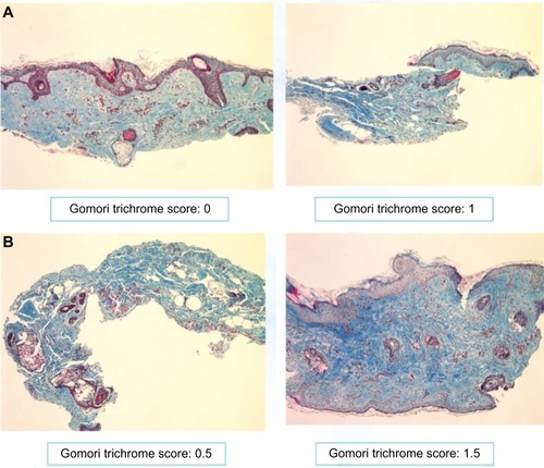 Figure 7 Gomori staining of retroauricular biopsy samples: (A) week 0; (B) week 12.