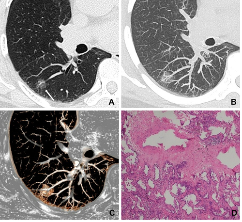 Figure 5 A 48-year-old woman with minimally invasive adenocarcinoma. (A) CT image shows a pure ground-glass nodule in the right lower lobe (white long arrow); (B and C) maximum intensity projection and volume rendering images show dilatation of intra-nodular vessels; (D) photomicrograph shows that the dilated vessels correspond to the proliferation of fibrous tissue surrounding vessels with invasion of tumor cells (hematoxylin-eosin stain, original magnification, ×100).
