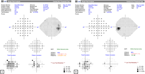 Figure 12 (A, B) Visual field test results obtained using the Humphrey visual field analyzer (HFA), showing no significant defects in the right eye.