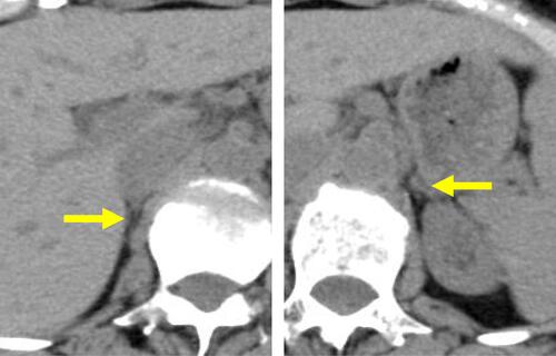 Figure 3 Abdominal computed tomography. Horizontal computed tomography images, without contrast, are shown. Yellow arrows indicate right and left atrophic adrenal glands.