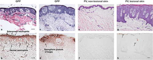 Figure 2. Histologic images of skin sections from patients with GPP (panels a to d) or PV (panels e to h) at comparable magnification, stained with hematoxylin and eosin (panels a, c, e, and g) and with anti-neutrophil elastase (panels b, d, f, and h). Panels a and b show edema of the epidermis with minimal acanthosis in a GPP lesion. Neutrophils are located at the surface in the subcorneal space (as would be seen in ‘lakes of pus’) and are abundant in the dermis. Panels c and d show moderate epidermal acanthosis in another case of GPP, with neutrophils located in mid-level epidermal vesicles, termed spongiform pustules of Kogoj, characteristic of a GPP diagnosis. The background, non-lesional skin from a patient with PV (panels e and f) has a normal-appearing epidermis and no neutrophils in the epidermis or dermis. A typical PV lesion (panels g and h) has marked epidermal acanthosis and rete pegs that are more elongated than in GPP. Neutrophil infiltration is variable in PV and may be largely absent. In this example, a few neutrophils can be seen in the mid-epidermis and stratum corneum, as shown by arrows. The epidermis in PV has much less edema than in GPP. Note the diffuse staining of neutrophil elastase in the epidermis of GPP (panels b and d), which indicates high levels of neutrophil degranulation with release of elastase into structural tissue of the epidermis. Bars in panels a, b, g, and h show 100 micrometers of length. Images courtesy of Dr. Krueger.GPP, generalized pustular psoriasis; PV, psoriasis vulgaris.