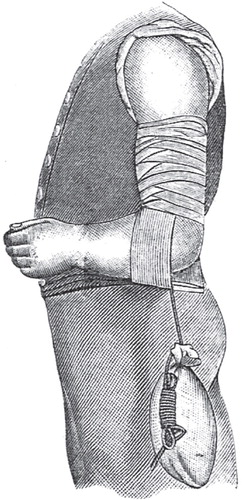 Figure 14. Adhesive plaster bandage and permanent traction. Reprinted from Hamilton (1865)154.