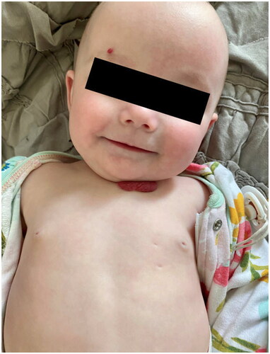 Figure 4. The surviving twin at eight months of age. Note the cardiocenteses sites.